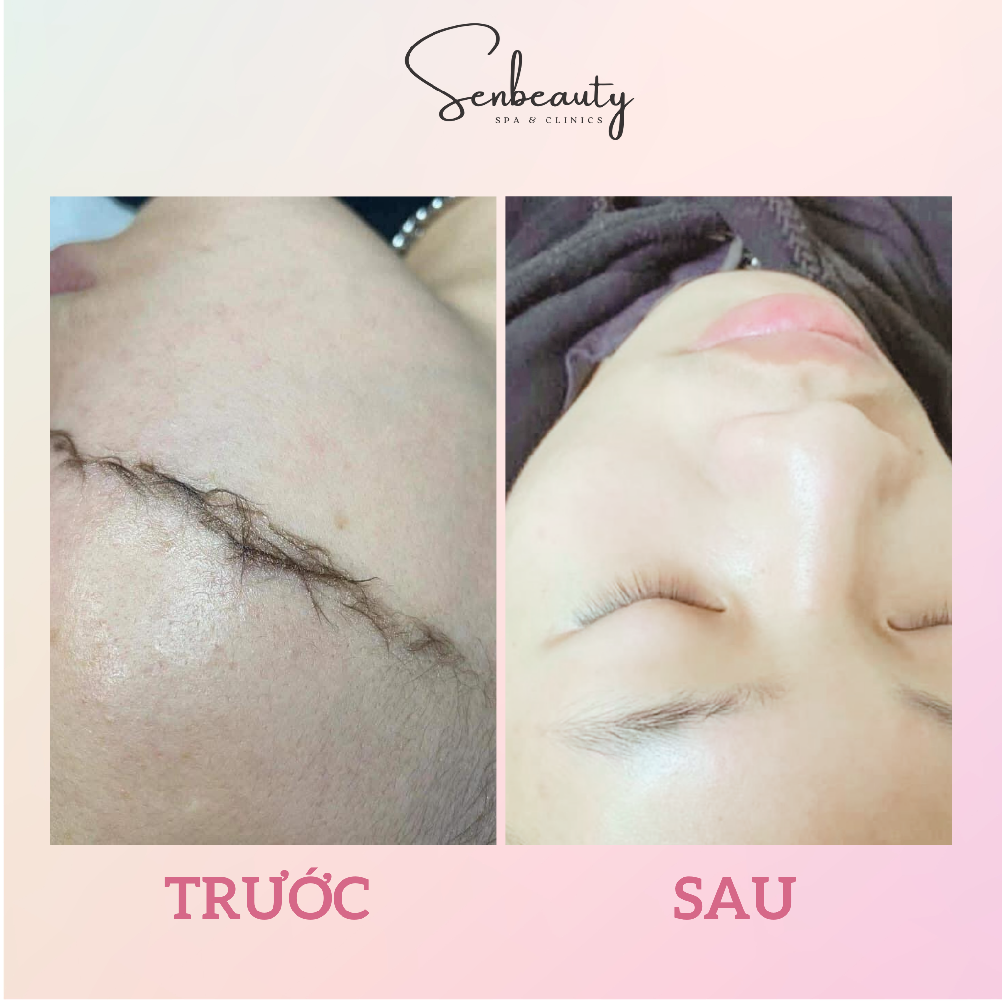 Hình ảnh kết quả triệt lông mặt